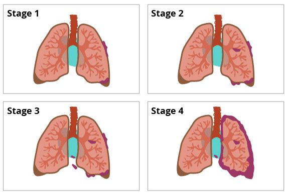 stages of lung cancer